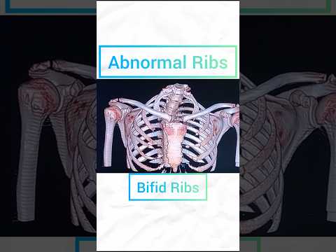 Bifid Ribs