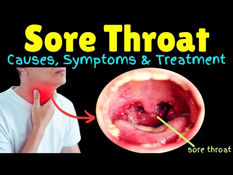 Sore Throat – Symptoms, Causes, Treatment, Complications & Prevention