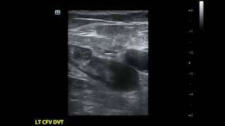 EHIT - Endothermal Heat Induced Thrombosis (EHIT)