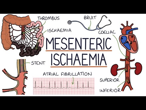 Understanding Mesenteric Ischaemia