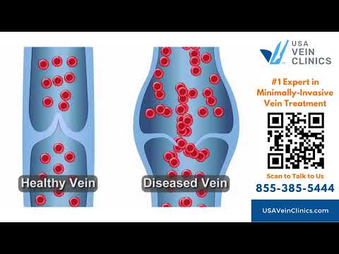 Minimally-Invasive Vein Treatment for Varicose Veins and Spider Veins at USA Vein Clinics