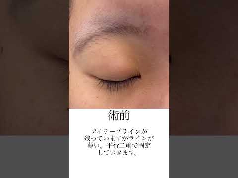 直後はこんな感じで腫れることがあります