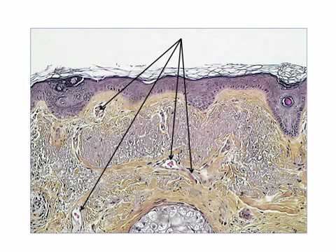 2 new dermoscopic criteria for LMM on the face by Dr. Luc Thomas