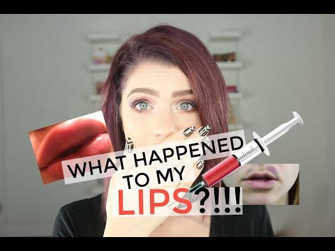 WHAT HAPPENED TO MY LIPS?!!! STORYTIME