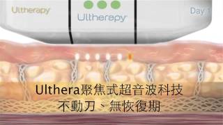 杏立博全 - Ulthera極線音波拉皮治療見證 (超音波拉提)