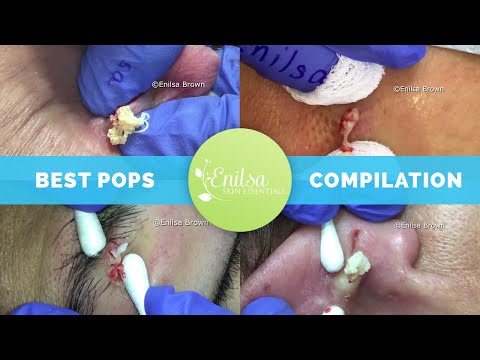 Enilsa's Top 5 Best Cyst Popping Compilation