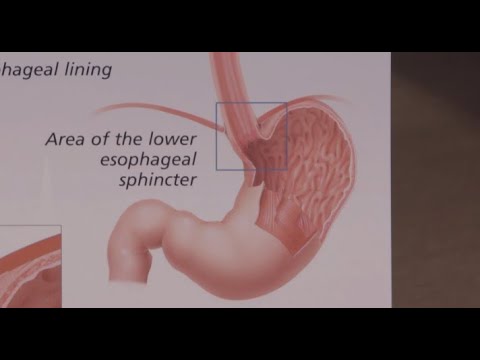 Understanding GERD