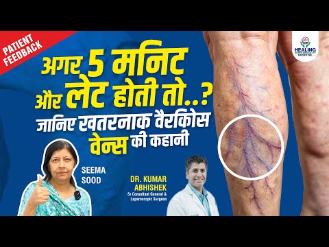 STOP Suffering from Varicose Veins with Critical Treatment