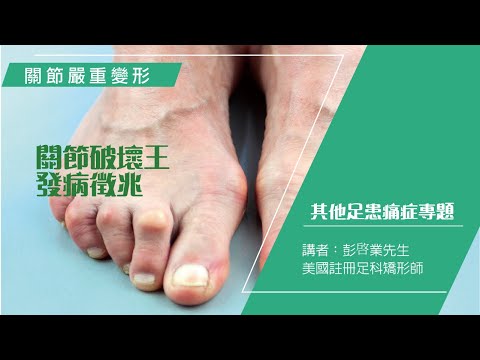 關節破壞王發病徵兆 –Pedorthic Technology 足科矯形