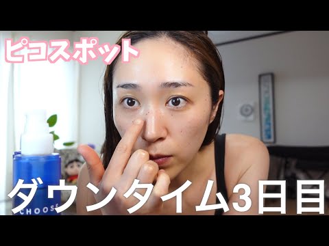 アラフォー【しみ治療3日目】ピコレーザー