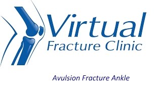 Avulsion fracture to ankle