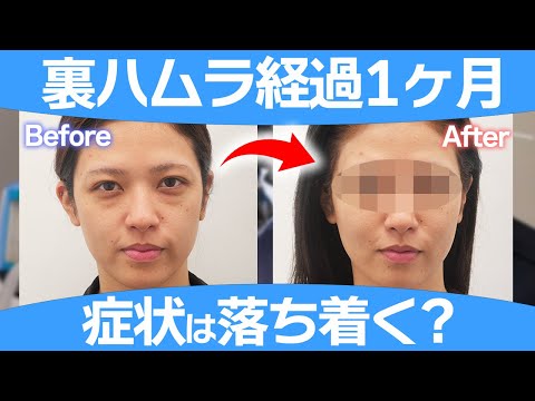 【凹みが気になる人必見！？】裏ハムラは1ヶ月くらいで落ち着いてきますか？術前と1ヶ月後の症例をお見せします。