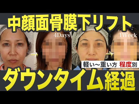 【ダウンタイム】中顔面骨膜下リフトの腫れが強い人、軽い人別で抜糸時から数週間、数ヶ月後まで大公開！