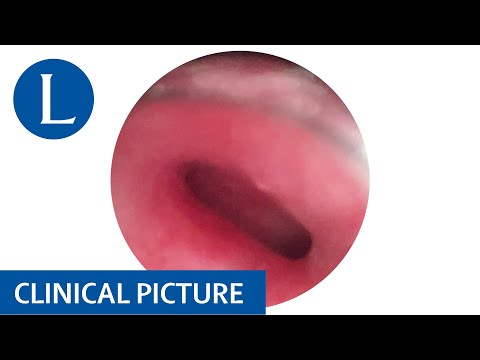 Stridor from birth indicates congenital upper airway obstruction