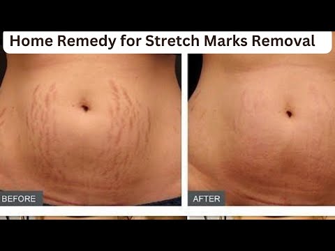 How to remove stretch marks with simple ingredients/Remove Stretch marks in an Organic way