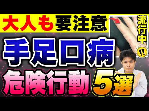 大人も要注意！手足口病の5つの勘違いとは？医師が解説