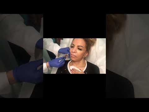 Vampire Facelift at Plantation Med Spa, Florida | Rejuvenate Your Skin Naturally #shorts