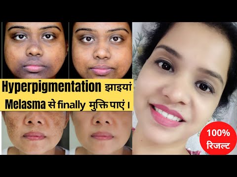 झाइयां Hyperpigmentation Melasma काले धब्बे brown spots finally हमेशा के लिए मुक्ति पाएं। 100% इलाज