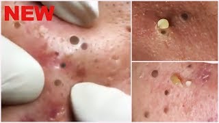 Deep Blackheads Removal from Cheeks and Nose - Best Pimple Popping Videos