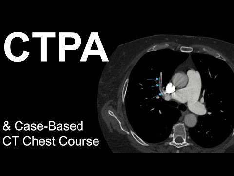 CT Pulmonary Angiogram: Pulmonary Embolism, Case-Based Course