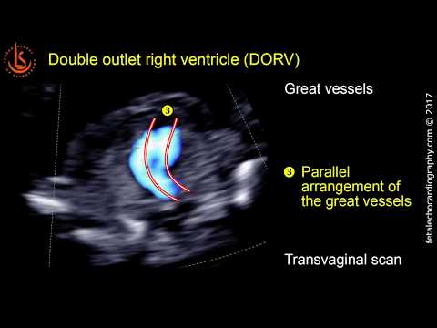 Fetal echocardiography at 11-13 weeks: Double Outlet Right Ventricle (DORV)