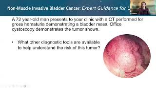 Non-Muscle Invasive Bladder Cancer (2024): Expert Guidance for Urologists