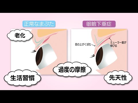 白山クリニックcm 眼瞼下垂症編