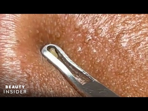 How Lip Blackheads Are Extracted | Beauty Insider