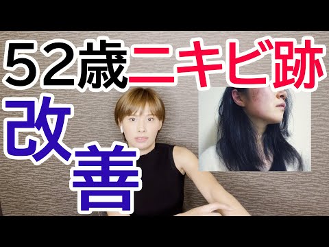 52歳でニキビ跡を改善する為に必要な2つの事とは？