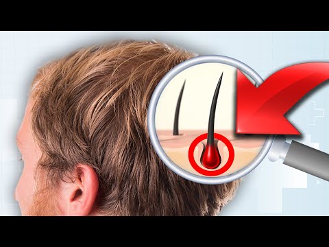 What Actually Causes Hair Loss?