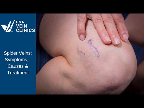 Spider Veins: Symptoms, Causes  &Treatments