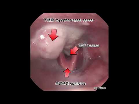 下咽癌 Hypopharyngeal cancer