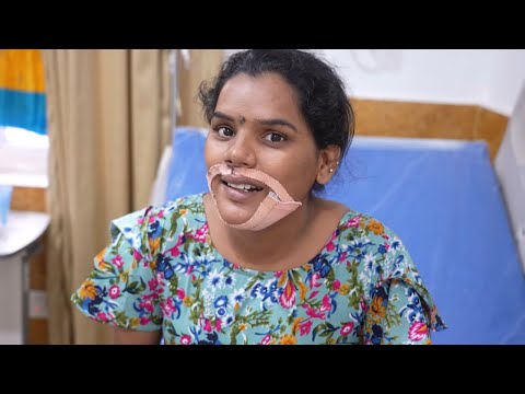 A Successful Jaw Surgery Result - Before And After | Best Jaw Surgery In Bangalore