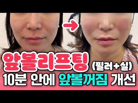 앞볼꺼짐 처짐 시술만으로 간단하게 볼륨 만드는 방법 (전후 사진)