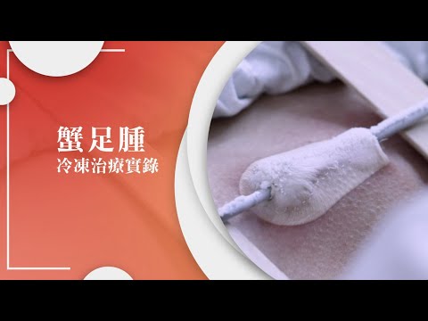 【手術室直擊】蟹足腫冷凍治療實錄｜凸起疤痕怎消除？｜香港疤痕治療