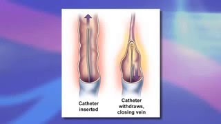 Varicose Vein Management