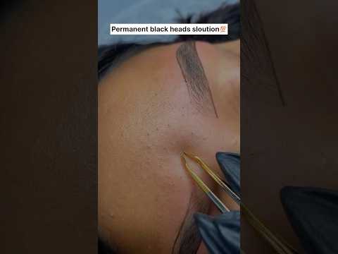 Permanent blackhead solution #shorts #youtube #blackheads #whiteheads #beautytips