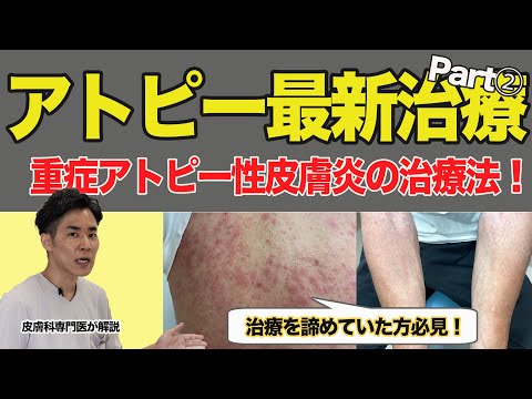 【アトピー最新治療法Part②】重症アトピー性皮膚炎の治療法！