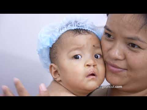 Successfully Completing Cleft Palate Surgery for a Baby