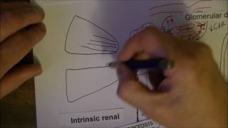 Acute Kidney Injury 2, Intrinsic and post renal causes of AKI