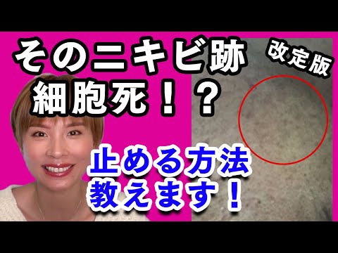 改定版　そのニキビ跡細胞死！？止める方法教えます！