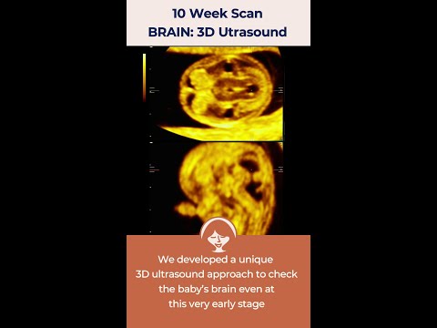 3D Scan of the BRAIN at 10 weeks