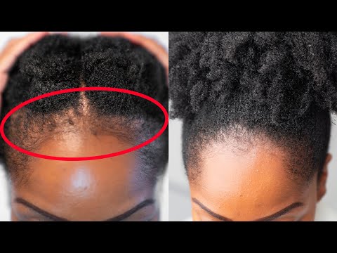 GROW Back Your EDGES FASTER with these 5 SIMPLE Tips!