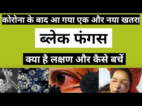 Black fungus | Mucormycosis | Black Fungus Kya Hai | Black Fungus Covid |  | Mucormycosis Symptoms