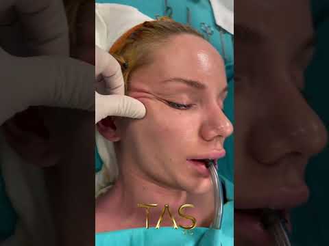 Scarless facelift & neck lift by the one and only Dr. Suleyman Tas