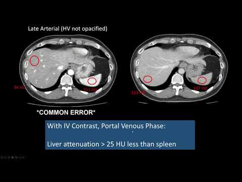 Interpreting CT Abdo: Background Liver, Hepatic Steatosis, High Attenuation Liver