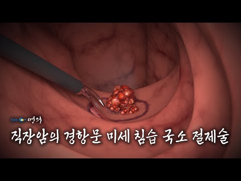 [명의 의학백과📖] 직장암의 경항문 미세 침습 국소 절제술