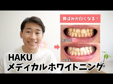 メディカルホワイトニングHAKUで黄ばみまくった歯は白くなるのか？