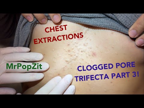 Clogged pores on the chest part 3! Blackheads, ingrown hairs,steatos,and vellus hair cysts extracted