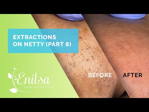 Blackhead Extractions on Netty - Eight Treatment